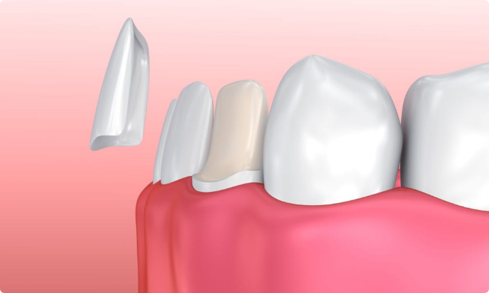 aesthetic-dentistry-ceramic-veneers-2