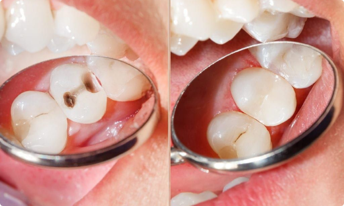 aesthetic-dentistry-composite-filling-2