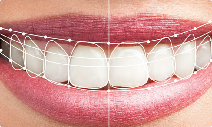 aesthetic-dentistry-smile-designing-1