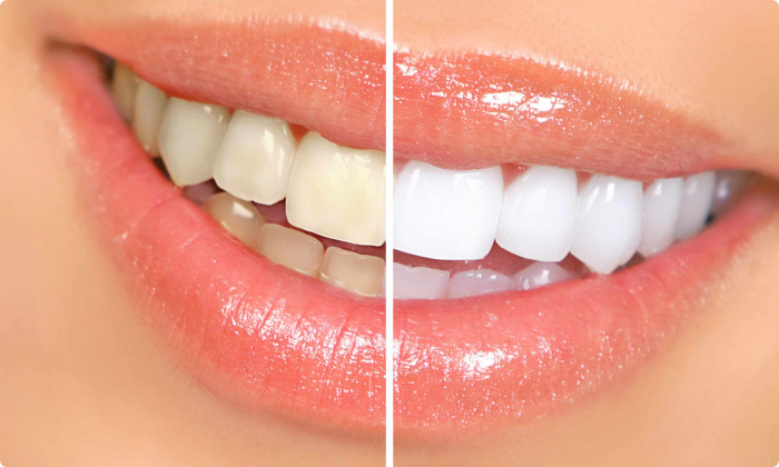 aesthetic-dentistry-teeth-whitening-1