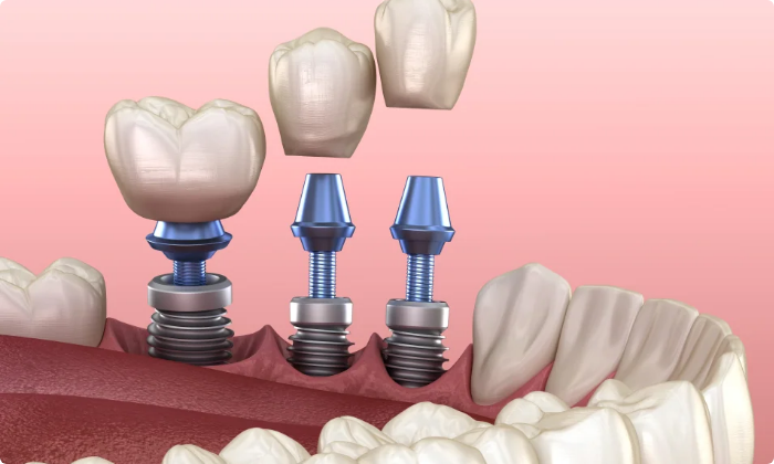 dental-implant-1