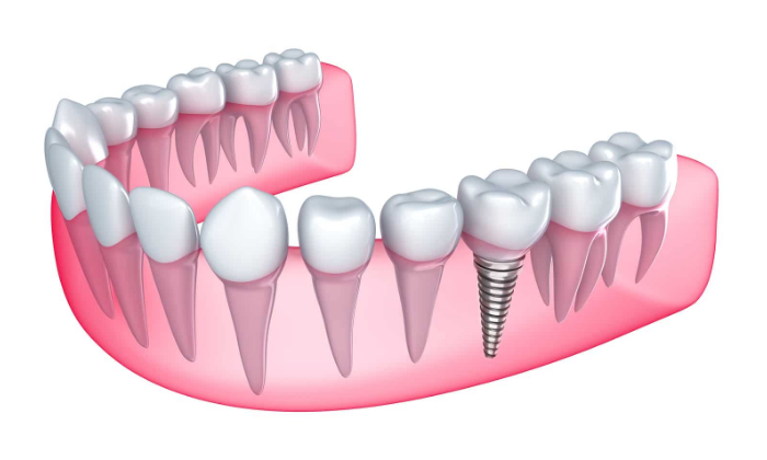 dental-implant-2