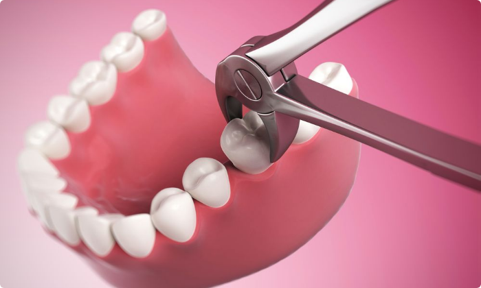 general-dental-treatment-extractions-1