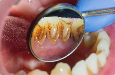 gum-treatment-and-surgery-3