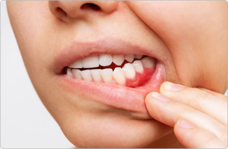 gum-treatment-and-surgery-4