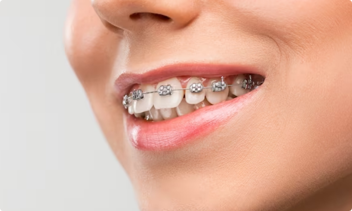 orthodontic-treatment-braces-1