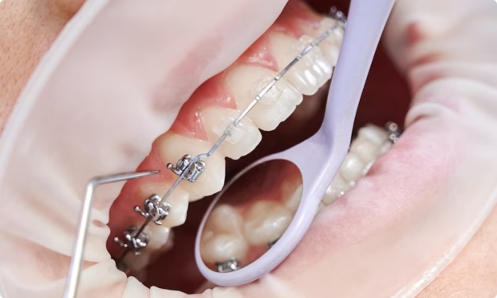 orthodontic-treatment-braces-2