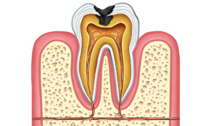 root-canal-treatment-2