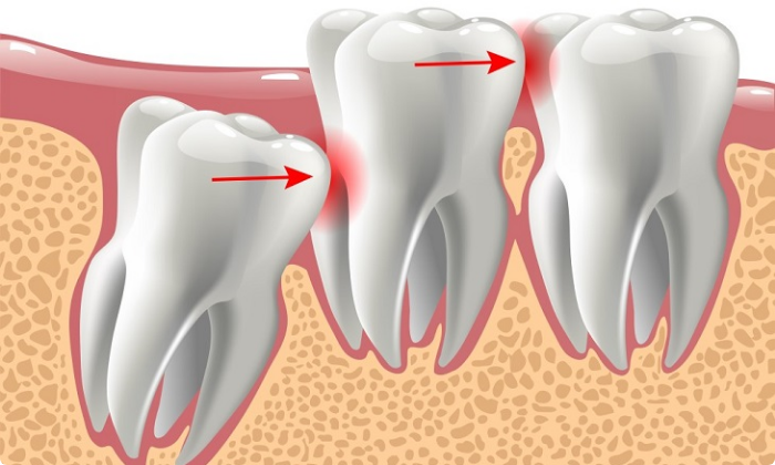 wisdom-tooth-removal-2