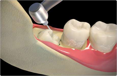 wisdom-tooth-removal-3